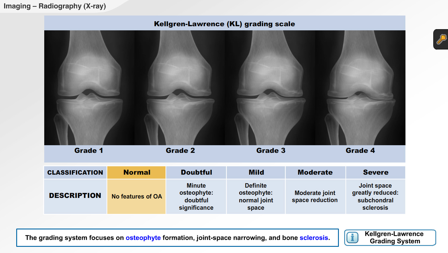 kaelgren lawrence grading of knee Osteoarthritis.jpg